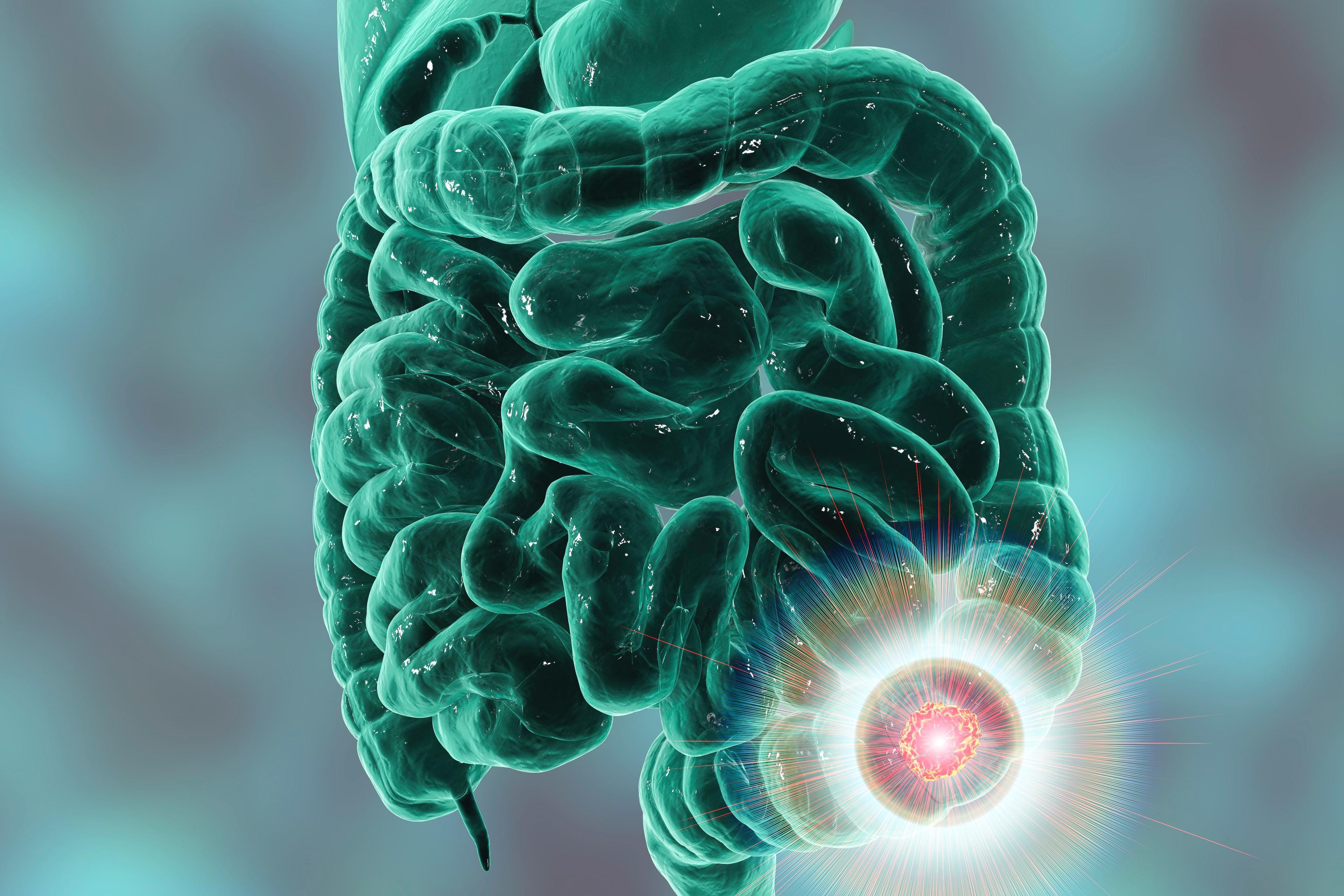 Studying Serum of Protein Biomarkers for Colorectal Cancer Detection Using LC-MS/MS